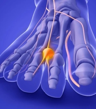 Νεύρωμα Morton